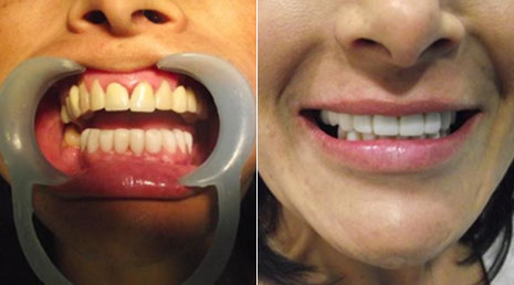 porcelain crowns cancun